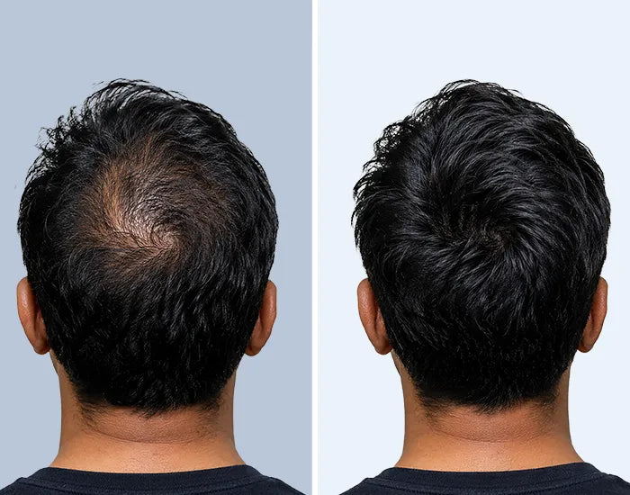 A side by side comparison of a man back of head showing hair density 