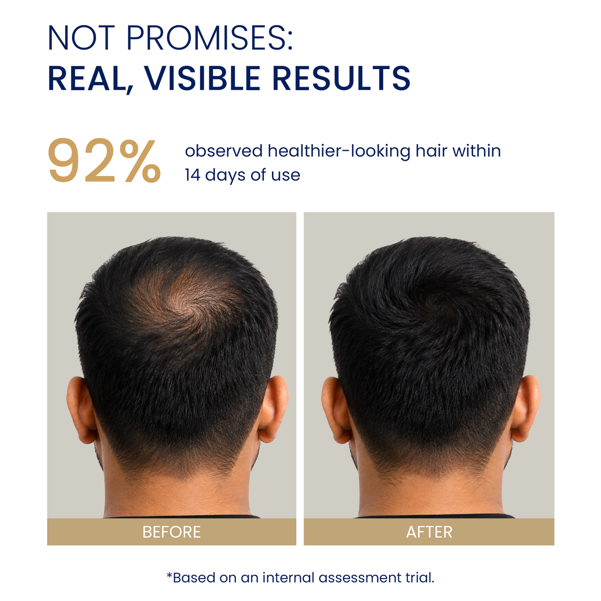 Before and after hair regrowth results showing increased density on crown